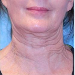 Sofwave Before & After Patient #1605